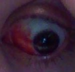 more bleeding eye