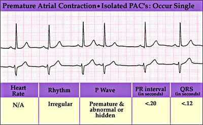 5 Risk Factors Identified For Premature Atrial Contractions